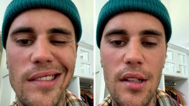Justin Bieber muestra la cruda realidad del síndrome que le paraliza media cara y le impide cantar